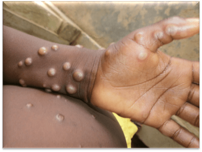 İngiltere'de bir kişiye maymun çiçeği virüsü hastalığı teşhisi (Monkeypox) kondu 2 mpx localized ncdc training manual.tmb 1366v