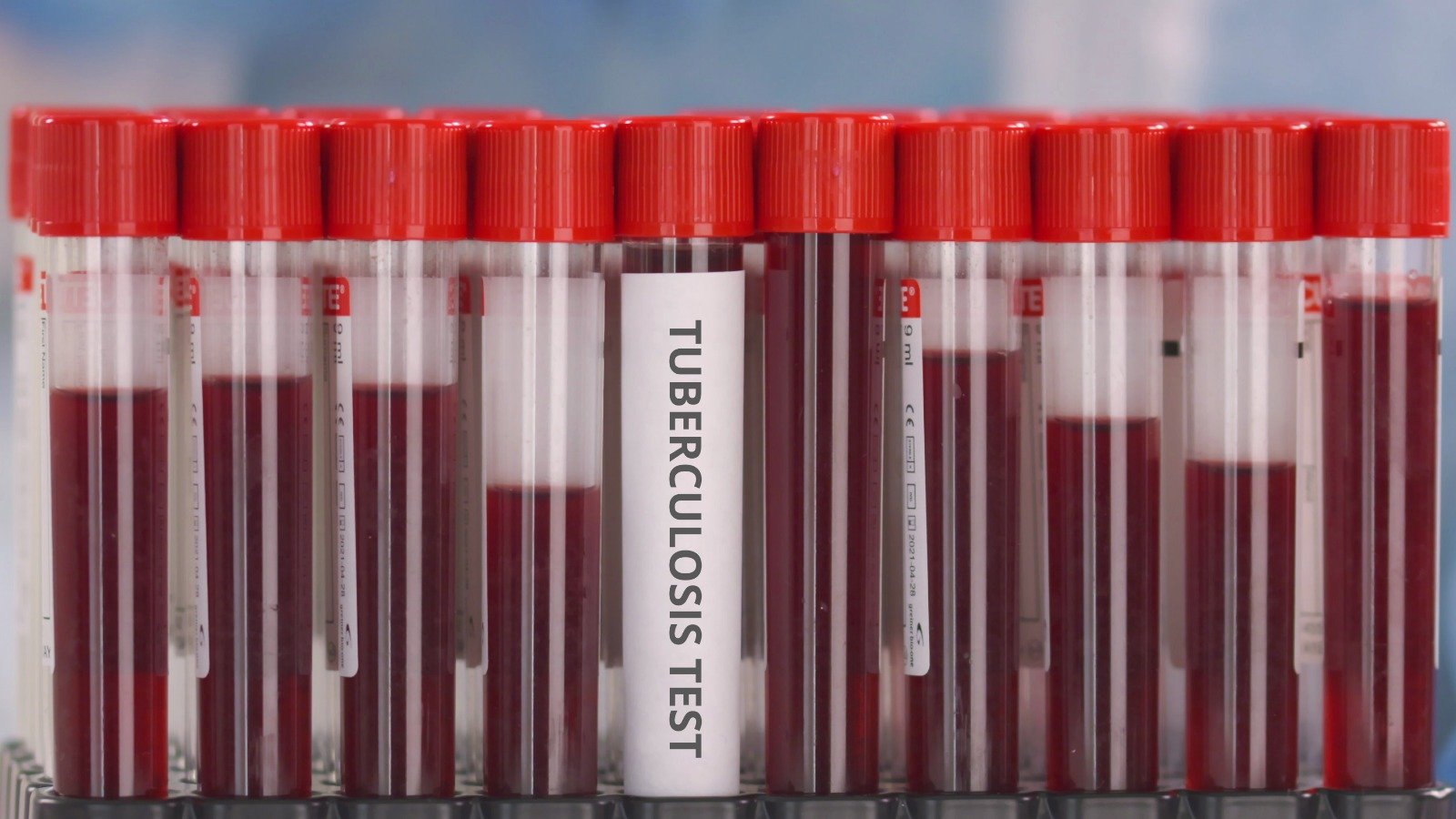Tüberküloz Vakaları İngiltere’de Yeniden Yükselişte 1 Tuberculosis